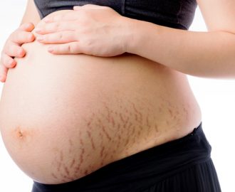 prevent pregnancy stretch marks
