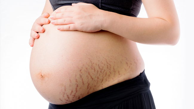 prevent pregnancy stretch marks