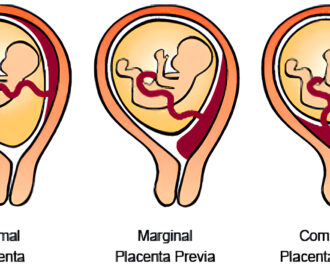 placenta pervia illustration