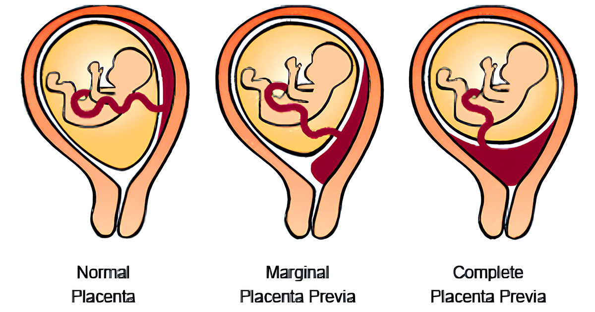 placenta pervia illustration