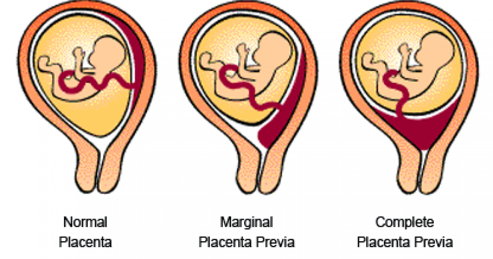 placenta pervia