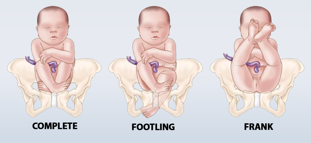 breech baby positions